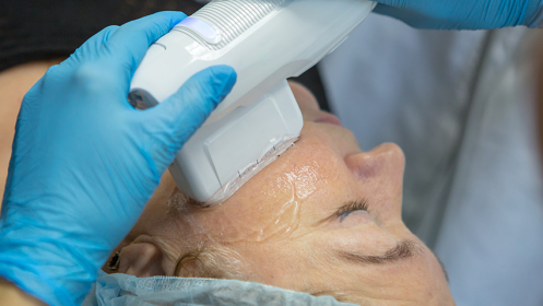 Rejuvenece tu rostro con Radiofrecuencia Indiba + HIFU Facial