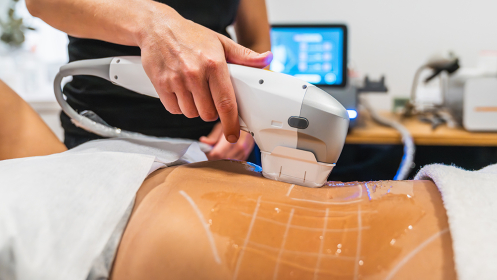 3 sesiones de Radiofrecuencia y tecnología HIFU: Despídete de la