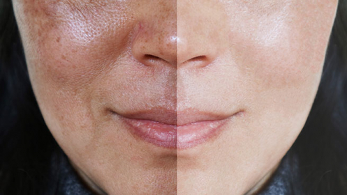 Escoge tu tratamiento facial radiofrecuencia o dermoabrasión